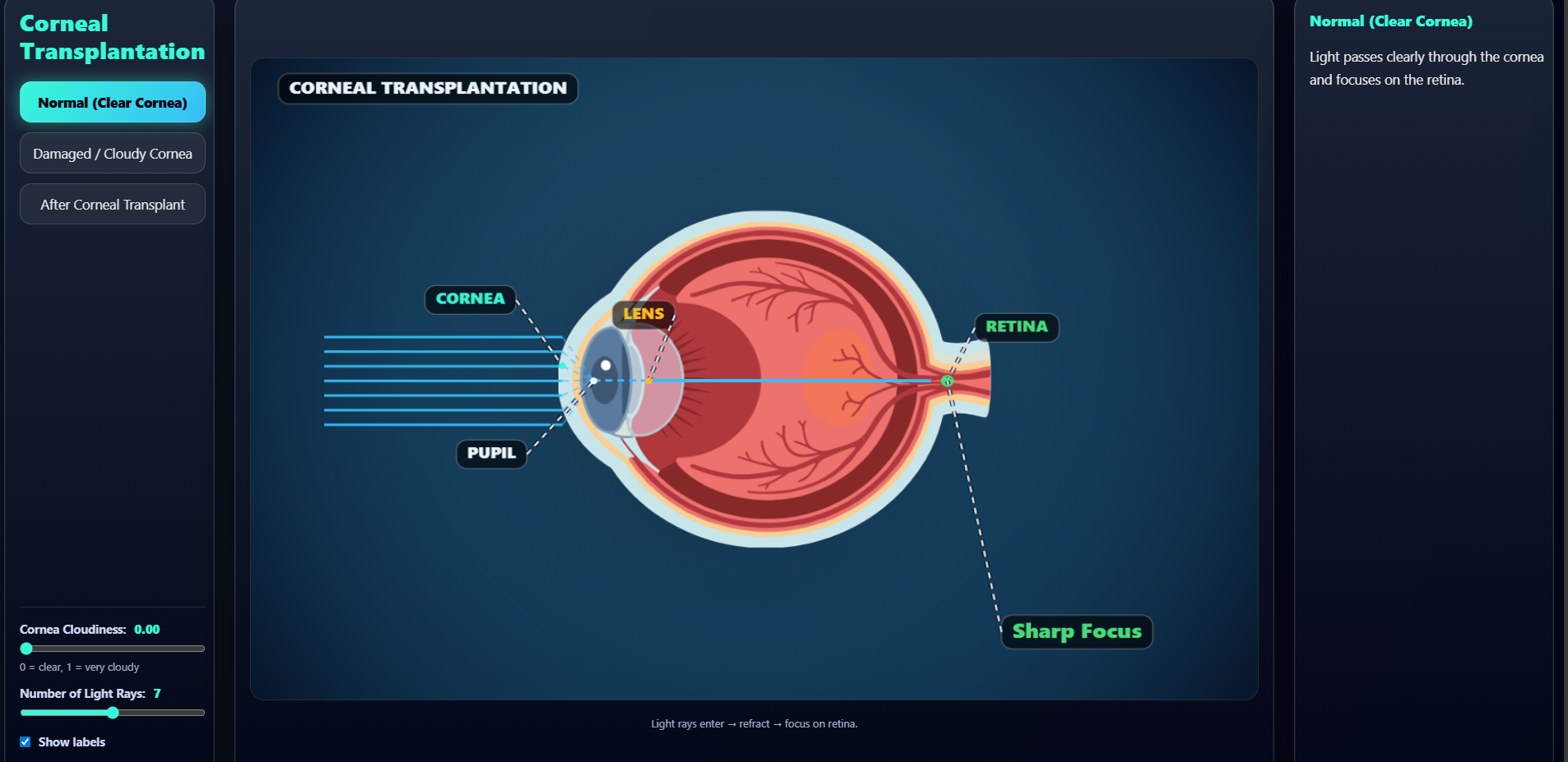 Corneal transplantation